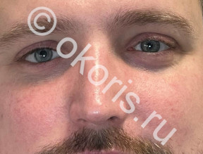 Шлифовка глазного протеза - важный этап его жизни Шлифовка глазного протеза - важный этап его жизни