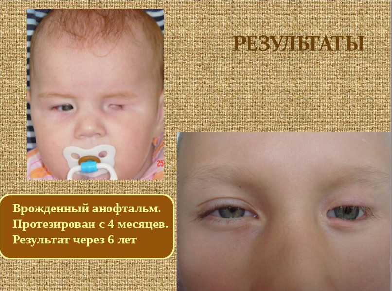 Анофтальм. Врожденная патология микрофтальм. Микрофтальм анофтальм. Врожденный анкилоблефарона. Микрофтальм глаза у ребенка.