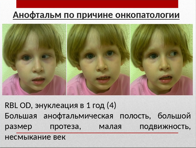 Анофтальм. Детки с глазными протезами.