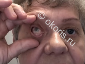 История травмы глаза в детском возрасте