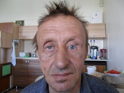 Малышевский Сергей Юрьевич, пациент Лаборатории глазного протезирования