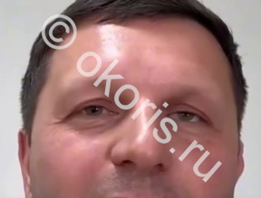 Пример длительного ношения глазного протеза. Не для подражания!