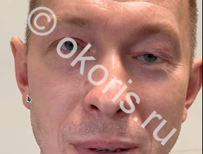 Глазное протезирование после ожоговой травмы